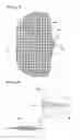 Fig. 04 - MEDICAL IMPLANT