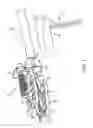 Fig. 02 - LUMBAR JACK IMPLANT