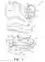 Fig. 02 - Prosthesis with modular extensions