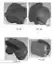 Fig. 43 - Patient-adapted and improved orthopedic implants, designs, and related tools