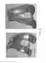 Fig. 115 - Patient-adapted and improved articular implants, designs and related guide tools
