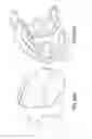 Fig. 134 - Patient-adapted and improved articular implants, designs and related guide tools