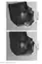 Fig. 141 - Patient-adapted and improved articular implants, designs and related guide tools