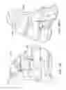Fig. 145 - Patient-adapted and improved articular implants, designs and related guide tools