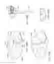 Fig. 150 - Patient-adapted and improved articular implants, designs and related guide tools