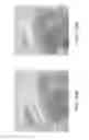 Fig. 162 - Patient-adapted and improved articular implants, designs and related guide tools