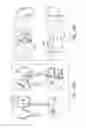Fig. 17 - Patient-adapted and improved articular implants, designs and related guide tools