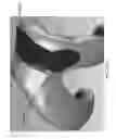 Fig. 170 - Patient-adapted and improved articular implants, designs and related guide tools