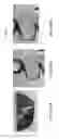Fig. 191 - Patient-adapted and improved articular implants, designs and related guide tools