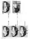 Fig. 192 - Patient-adapted and improved articular implants, designs and related guide tools