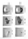 Fig. 197 - Patient-adapted and improved articular implants, designs and related guide tools