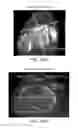 Fig. 199 - Patient-adapted and improved articular implants, designs and related guide tools