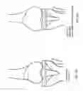 Fig. 37 - Patient-adapted and improved articular implants, designs and related guide tools
