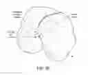Fig. 49 - Patient-adapted and improved articular implants, designs and related guide tools