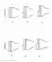 Fig. 97 - Patient-adapted and improved articular implants, designs and related guide tools