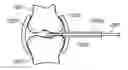Fig. 01 - RETRIEVAL OF ORTHOPEDIC JOINT DEVICE