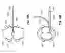 Fig. 13 - RETRIEVAL OF ORTHOPEDIC JOINT DEVICE