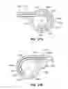 Fig. 25 - RETRIEVAL OF ORTHOPEDIC JOINT DEVICE