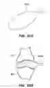 Fig. 28 - RETRIEVAL OF ORTHOPEDIC JOINT DEVICE
