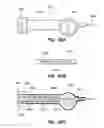 Fig. 33 - RETRIEVAL OF ORTHOPEDIC JOINT DEVICE