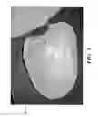 Fig. 04 - Orthotic device for preventing and/or correcting deformational posterior plagiocephaly