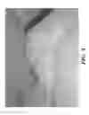 Fig. 06 - Orthotic device for preventing and/or correcting deformational posterior plagiocephaly