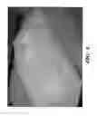 Fig. 07 - Orthotic device for preventing and/or correcting deformational posterior plagiocephaly