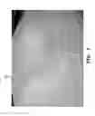 Fig. 08 - Orthotic device for preventing and/or correcting deformational posterior plagiocephaly