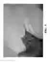 Fig. 09 - Orthotic device for preventing and/or correcting deformational posterior plagiocephaly