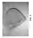 Fig. 10 - Orthotic device for preventing and/or correcting deformational posterior plagiocephaly