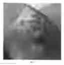 Fig. 04 - Debridement method using topical nitric oxide donor devices and compositions