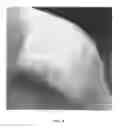 Fig. 06 - Debridement method using topical nitric oxide donor devices and compositions