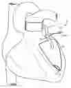 Fig. 01 - Devices and methods for absorbing, transferring and delivering heart energy