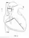 Fig. 04 - Devices and methods for absorbing, transferring and delivering heart energy