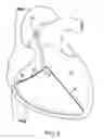 Fig. 06 - Devices and methods for absorbing, transferring and delivering heart energy