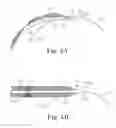 Fig. 07 - Surgical articles and methods for treating pelvic conditions