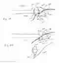 Fig. 09 - Surgical articles and methods for treating pelvic conditions