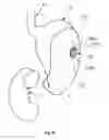 Fig. 09 - Surgical port for notes procedures