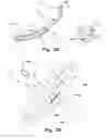 Fig. 03 - Endoluminal medical access device