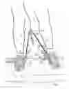 Fig. 02 - Assisting device for adopting the correct posture of lower limbs and for pursuing walking activity