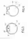 Fig. 03 - Colonic lavage catheter