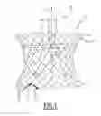 Fig. 02 - Prosthetic implant