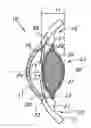 Fig. 01 - Accommodating intraocular lens assemblies and accommodation measurement implant
