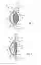 Fig. 02 - Accommodating intraocular lens assemblies and accommodation measurement implant