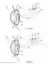 Fig. 07 - Accommodating intraocular lens assemblies and accommodation measurement implant