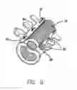 Fig. 05 - Bone anchored surgical mesh