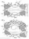 Fig. 08 - TOROID-SHAPED SPINAL DISC