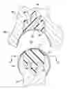 Fig. 01 - Artificial wear resistant plug for mounting to existing joint bone