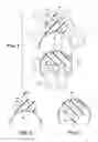 Fig. 02 - Artificial wear resistant plug for mounting to existing joint bone