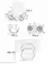 Fig. 04 - Artificial wear resistant plug for mounting to existing joint bone